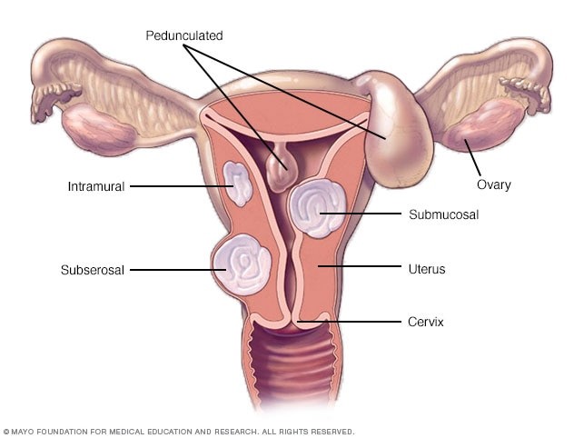 Fibromas 1