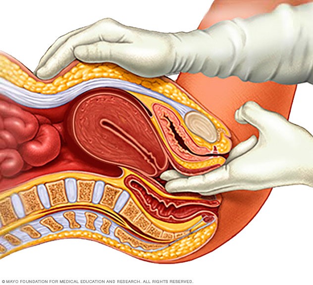 Fibromas 1