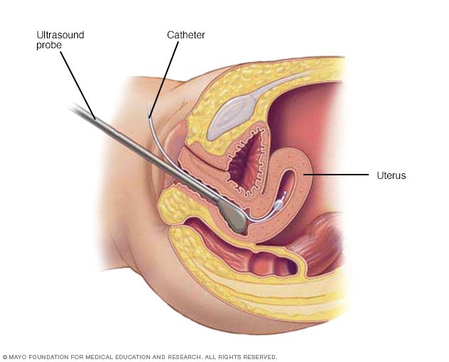 Fibromas 1