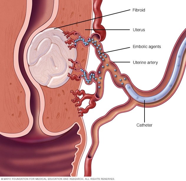 Fibromas 1